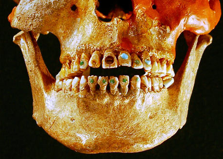 The History of Grillz: From Ancient Gold to Modern Hip-Hop Culture